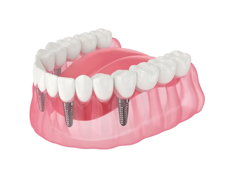 All-on-4 full arch implants