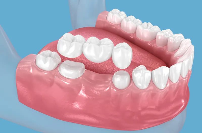 Dental crowns and bridge