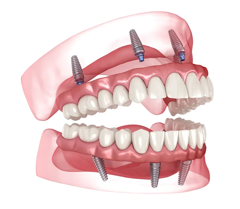 Full mouth restorative dentistry