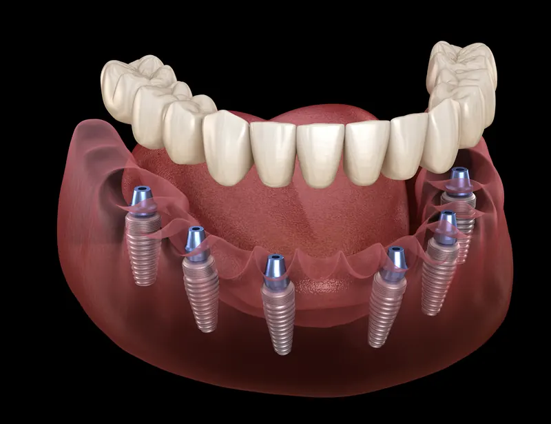 Implant-supported denture