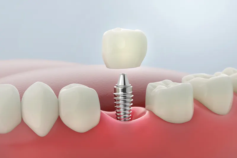 Single tooth implant with crown